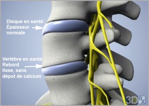ARTHROSE ET DÉCOMPRESSION NEUROVERTÉBRALE Décompression neurovertébrale