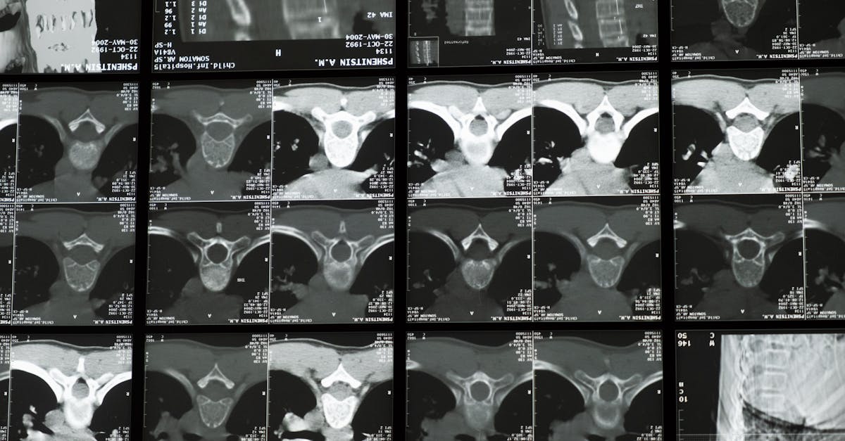 discover the benefits of spinal decompression, an innovative method for relieving back pain and improving your well-being. learn how this technique can restore flexibility to your spine and promote a better quality of life.