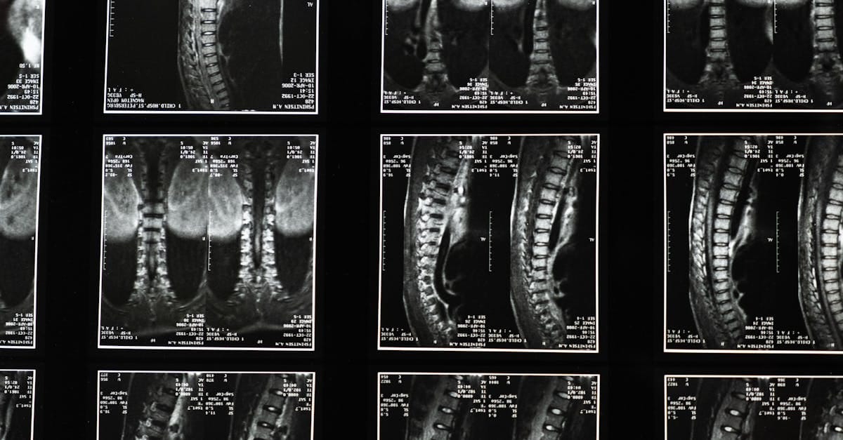discover the benefits of spinal decompression, an innovative method to relieve back pain and improve mobility. learn how this technique can help you regain your well-being and live pain-free.